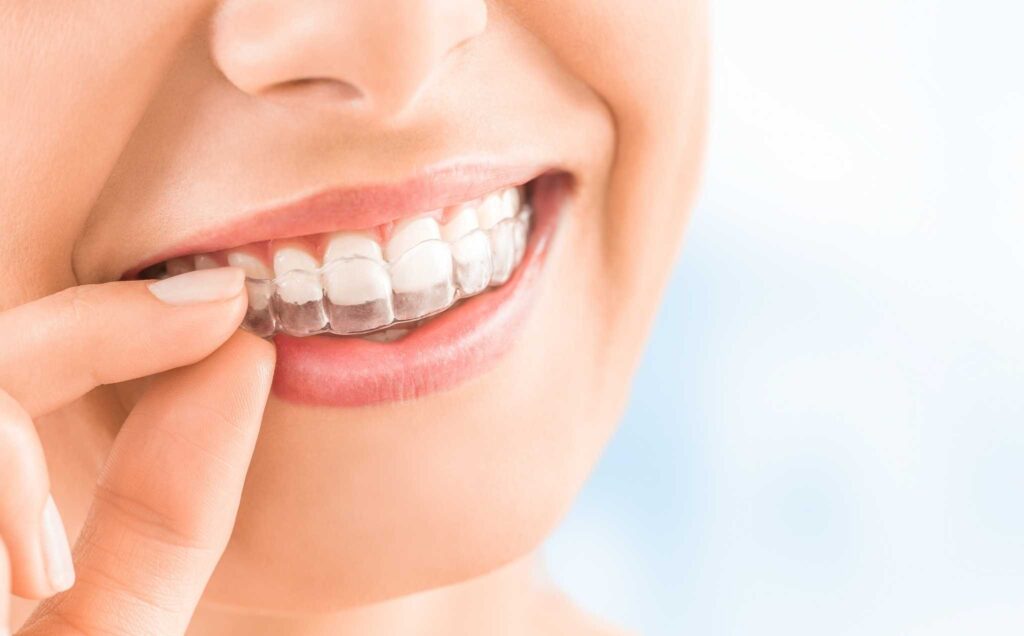 Removable retainers, Invisalign retainers, Essix Retainers at Super Orthodontics In Encino, Los Angeles Removable retainers, Invisalign retainers, Essix Retainers at Super Orthodontics In Encino, Los Angeles