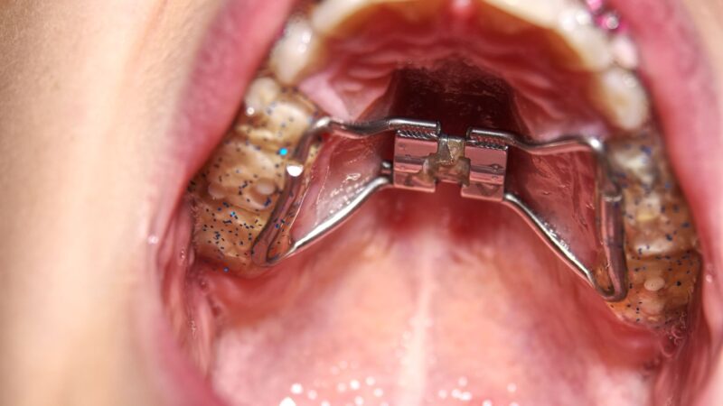 Kids Palate Expanders | Encino, Los Angeles | Super Orthodontics