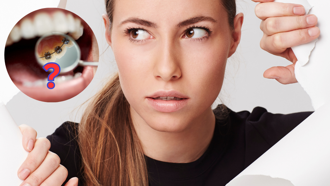 Alternatives to InBrace and Lingual Braces