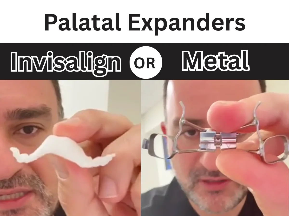 Palatal Expanders by Super Orthodontics, including Metal and Invisalign Expanders
