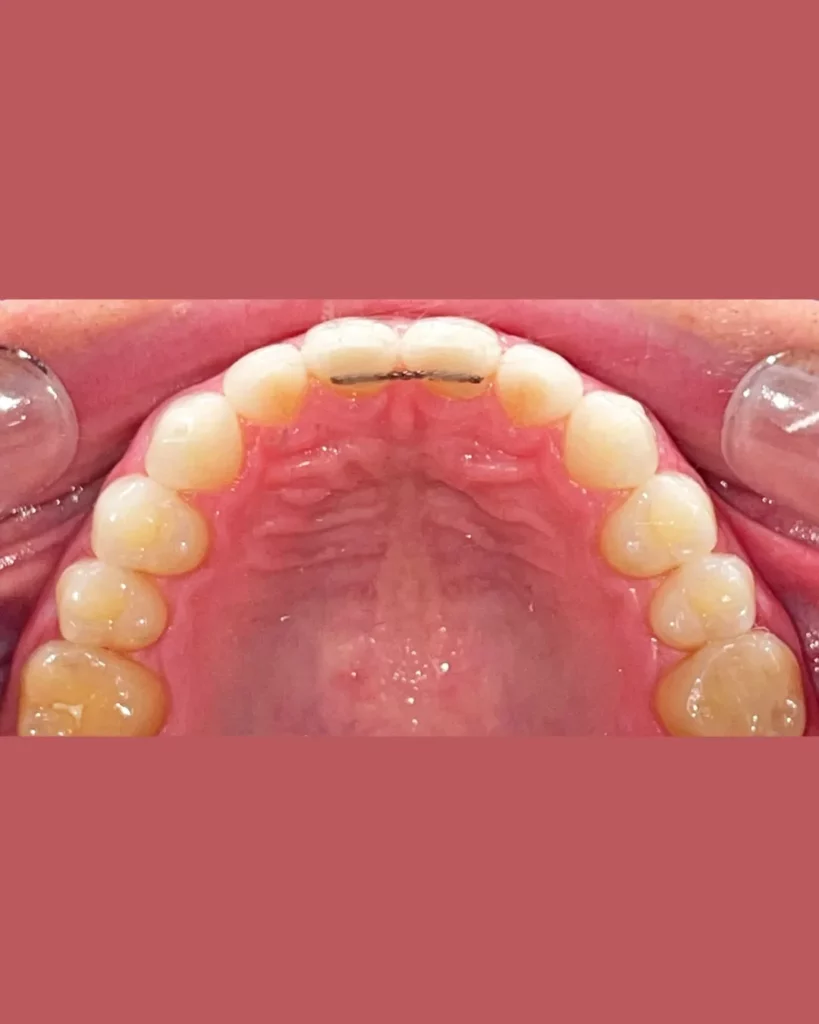 Fix (Permanent) Retainers in Encino, Los Angeles, and nearby communities Fix (Permanent) Retainers in Encino, Los Angeles, and nearby communities